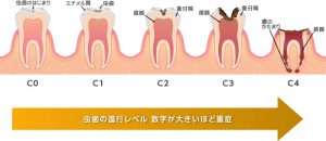 むし歯になるのはどうして？