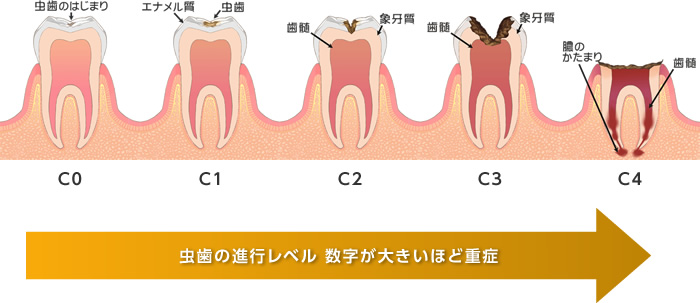むし歯の進行と痛みの種類