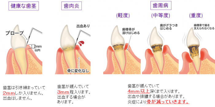 歯周病ってなに？？