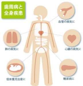 歯周病と全身に現れる病気の関係性