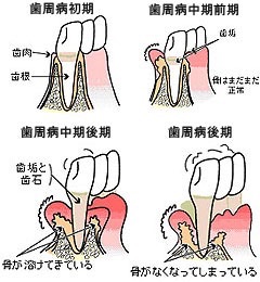 知らなかったでは手遅れになってしまう歯周病のおはなし！