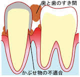 虫歯の2大原因菌｜ミュータンス菌とラクトバシラス菌