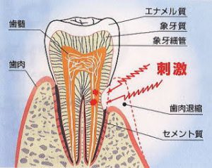 【知覚過敏の原因】ピリッとくるのはあれが原因です！｜高槻駅すぐの歯科「宮地歯科医院」