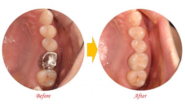 銀歯・セラミックどっちの治療？？メリットやデメリットを解説