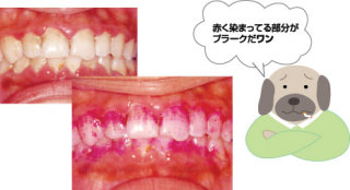 歯垢（プラーク）って何？｜プラーク1mgの中に約10億個の細菌？？