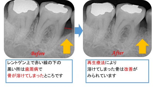 再生療法とは？歯周病の最先端の治療