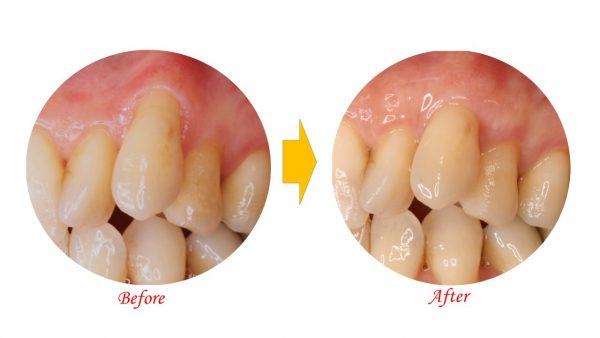 歯ぐきが下がってしまった｜結合組織とは？