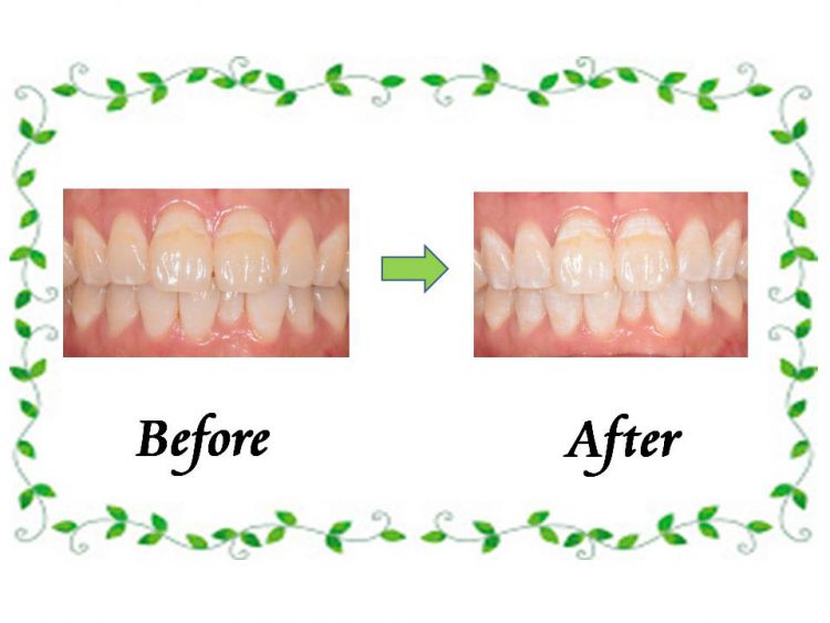 わたしのホワイトニング体験