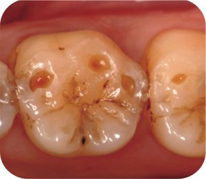 虫歯ではないですが歯が溶けてしまう病気「酸蝕症」