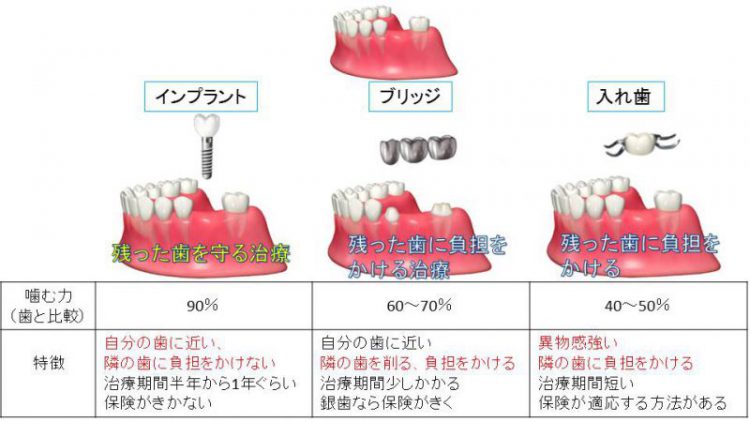 歯がなくなってしまった時！！ ～インプラント・ブリッジ・入れ歯の比較～