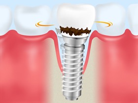 インプラントも歯周病になってしまうの？？