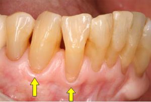 歯茎が痩せる「歯肉退縮」とは？