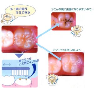 お子様のむし歯予防にシーラントを！！