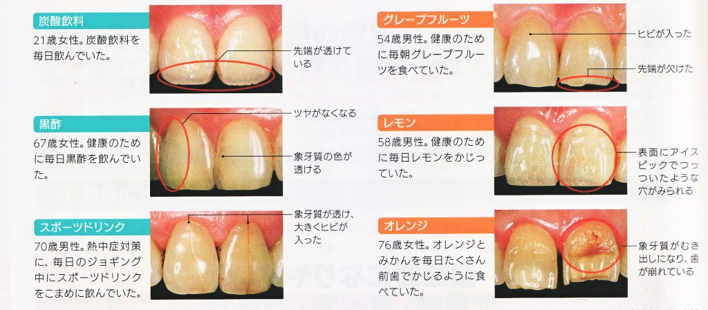 酸蝕歯を招く食生活の落とし穴