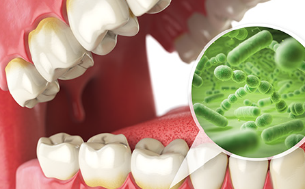 歯を失う最大の原因である疾患歯周病治療