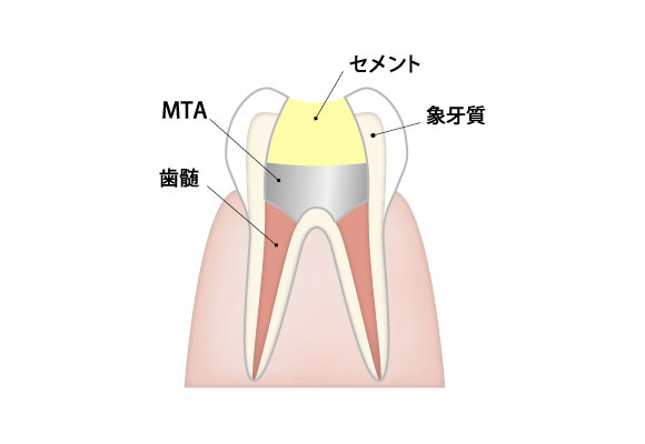 歯髄温存療法とは