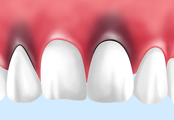 歯茎の見た目も改善できます