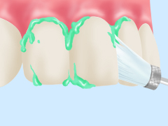 歯の汚れを落としクリーニング
