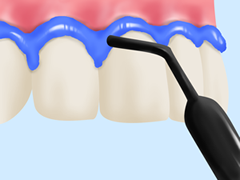 保護剤を塗って歯ぐきを保護