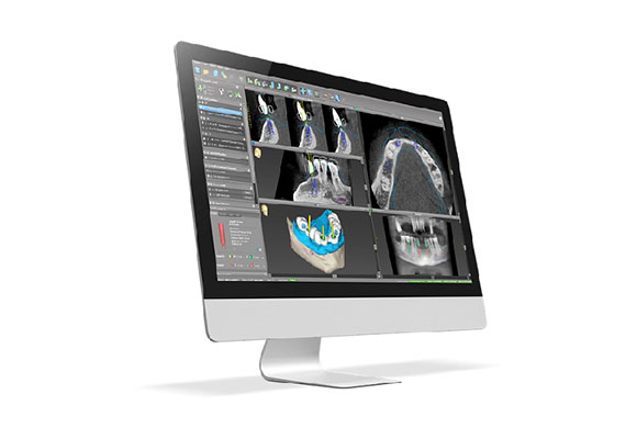 02.デジタルシミュレーションによる綿密な治療計画の立案