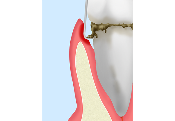 歯周ポケット掻爬術