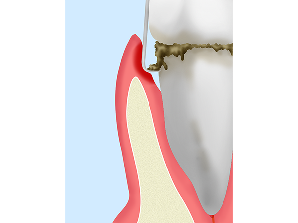歯周ポケット掻爬術
