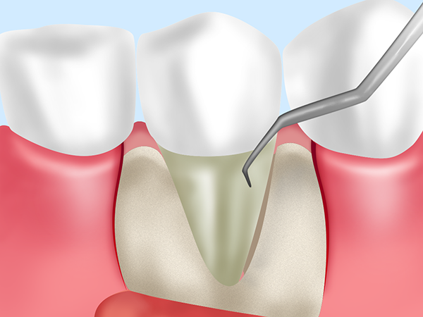 歯肉剥離掻爬術（＝フラップ手術）